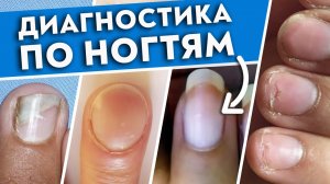 Как определить болезнь по ногтям?
Ногти скажут всё о вашем здоровье!