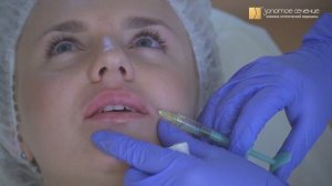 Контурная пластика губ. Результат до и после увеличения губ. Естественная коррекция формы губ!