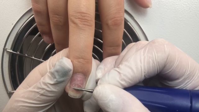 ОНИХОЛИЗИС. Положительная динамика