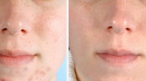 Бурун устидаги кора нукталарни энг осон давоси,меновазин от черных точек