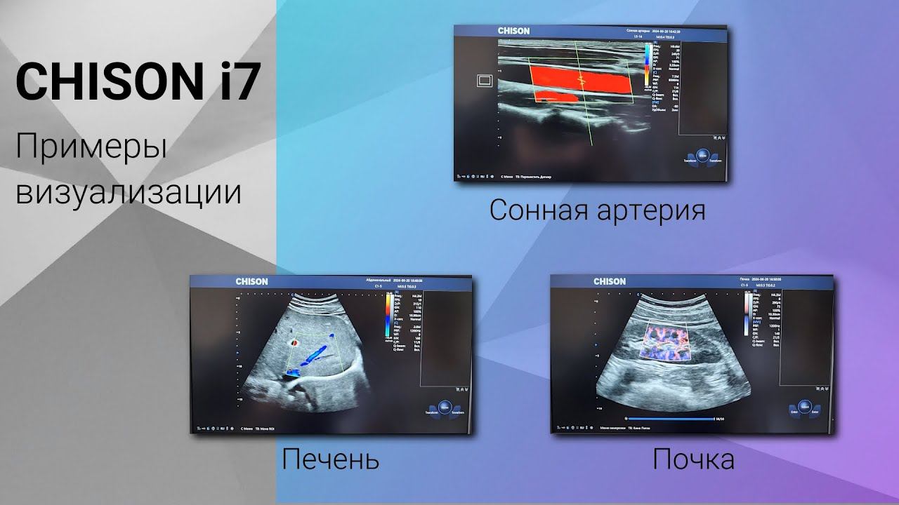Chison i7 примеры визуализации смотреть онлайн