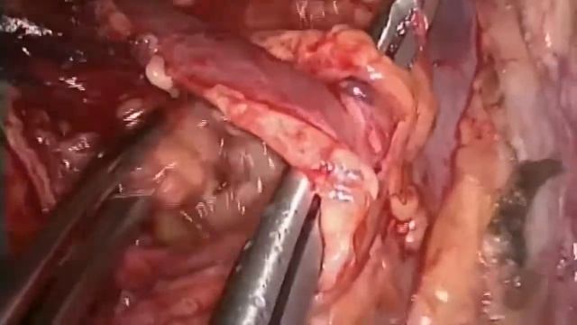 Asvide: Paratracheal mediastinal lymph node dissection смотреть онлайн