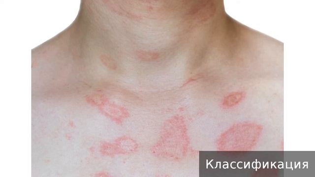 Многоформная эритема Как лечить многоформную эритему смотреть онлайн