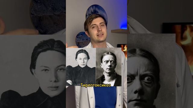 Как меняется внешность из-за щитовидки #эндокринолог #щитовиднаяжелеза смотреть онлайн