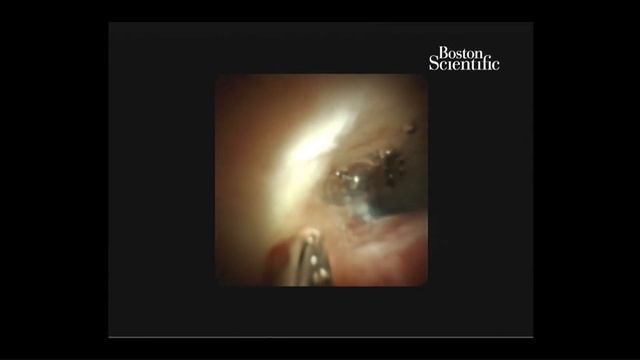 Spyglass Cholangioscopy with Use of Spybite Max forceps смотреть онлайн