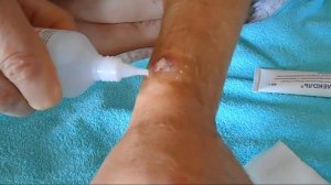 Перевязка раны в домашних условиях.