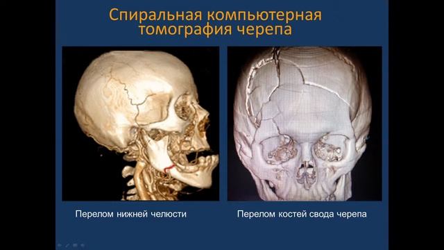 Рентгенанатомия органов опоры и движения. Потоки В, Д. 18.10.21 - 14:15 смотреть онлайн