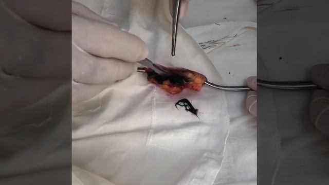 Удаление эпителиально-копчиковой кисты в Махачкале