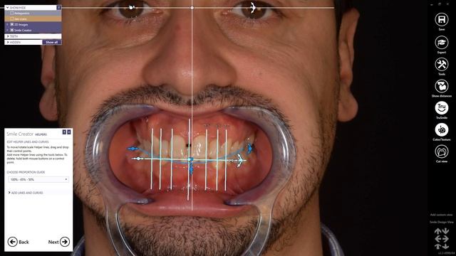 Exocad Quick Guide: Learn Smile Creator In 7 Min!