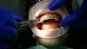 Снятие брекетов