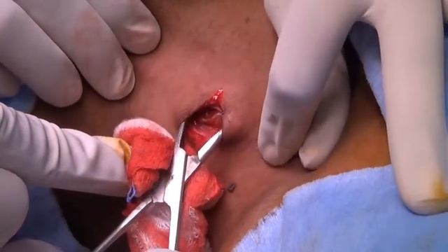 Cervical Lymph node biopsylocal anaesthesia смотреть онлайн
