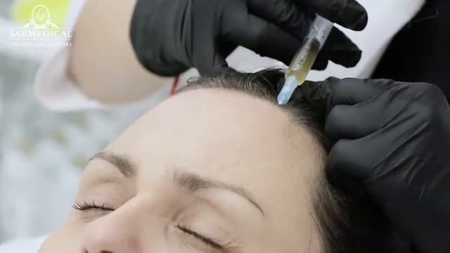 Плазмотерапия волосистой части головы в Sarmedical смотреть онлайн