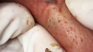 Удаление акне!Прыщи выдавливание!Выдавливание прыщей!