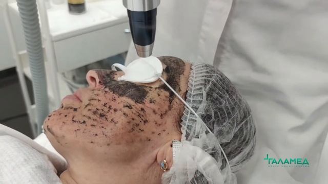 Фотоомоложение + Карбоновый пилинг Галамед смотреть онлайн