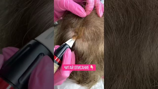 Залысина на голове что делать? Частичное облысение. Очаговая алопеция смотреть онлайн