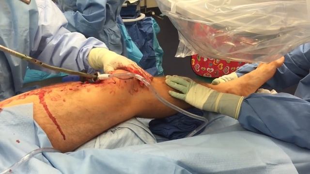 Suprapatellar Tibial Nailing for Segmental Tibia Fracture - Broken Leg Surgery смотреть онлайн