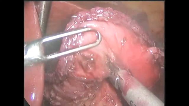 Мини-гастрошунтирование (MGP) смотреть онлайн