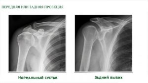 Рентген диагностика заболеваний плечевого сустава | Травматология и ортопедия