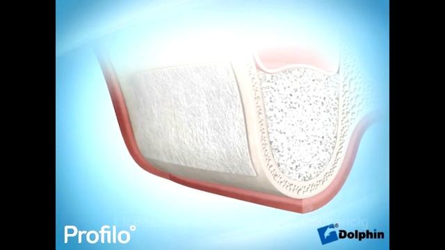 Sinus Lift and Dental Implants смотреть онлайн