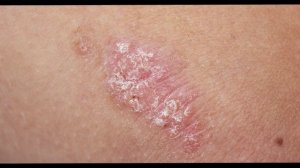 Как лечить потницу у взрослых