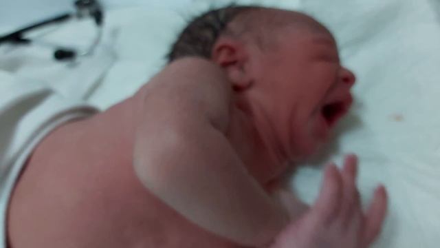 Examination Of  Sandifer Syndrome (GERD, Dystonia Opisthotonus)stiff, Tilt Head, Thrashing Limbs