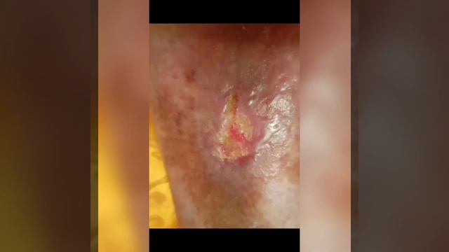 varikoz agirlasmasi fesad trofiki xora damar yarasi endovenoz lazer ablasiya lipodermatoskleroz IDP смотреть онлайн