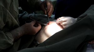 Хирургия.  Удаление фиброаденомы молочной железы.