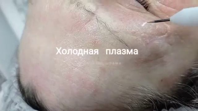 Обработка холодной плазмой. смотреть онлайн