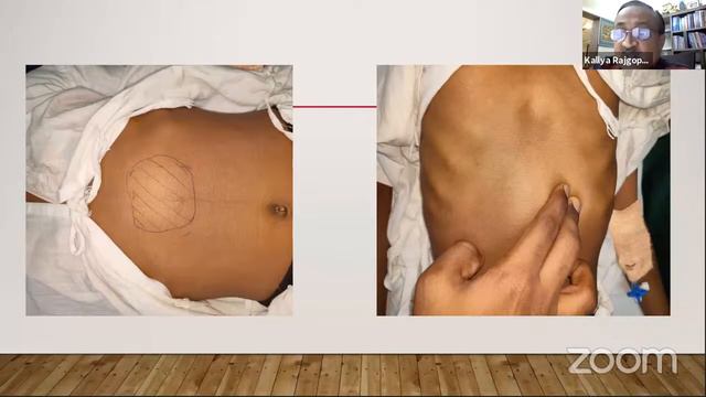 PSEUDOCYST OF PANCREAS Clinical case presentation смотреть онлайн