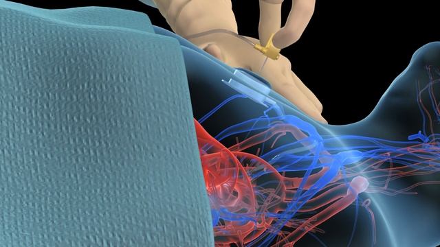 Accessing an implantable port training - 3D animation смотреть онлайн