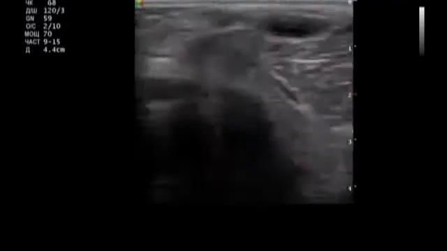 Медиальный мениск