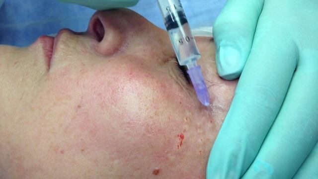 Обучение биоревитализация показ преподавателя смотреть онлайн