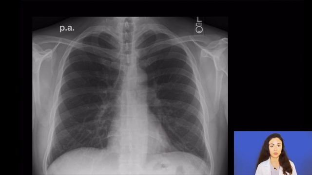 РЕНТГЕН грудной клетки. Как читать рентген как радиолог? смотреть онлайн