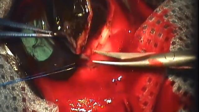 Лимбальная меланоцитома у собаки смотреть онлайн