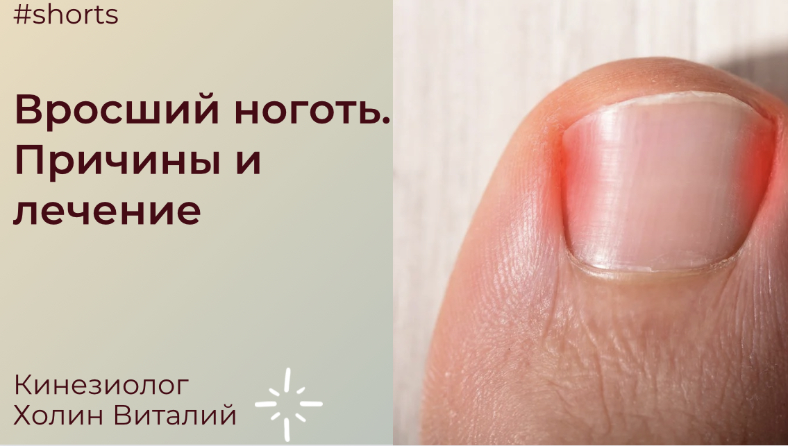 Вросший ноготь. Причины и лечение смотреть онлайн