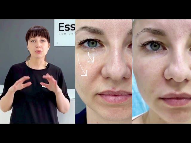 Филлеры, глубокое введение смотреть онлайн