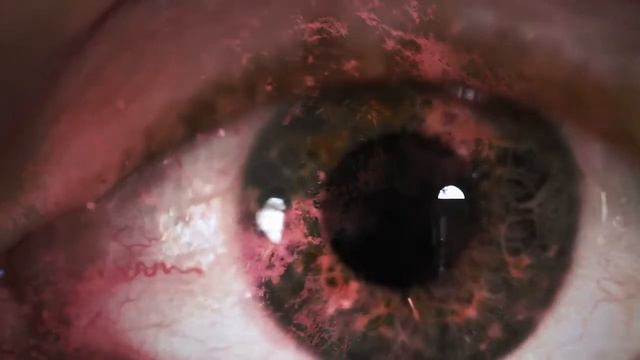 Что будет если выдавить ячмень на глазу