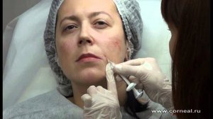 Коррекция верхней трети и носогубной складки канюлей