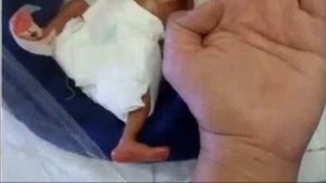 Самый недоношенный ребенок в мире, весом всего 400 граммов выжил вопреки прогнозам врачей!