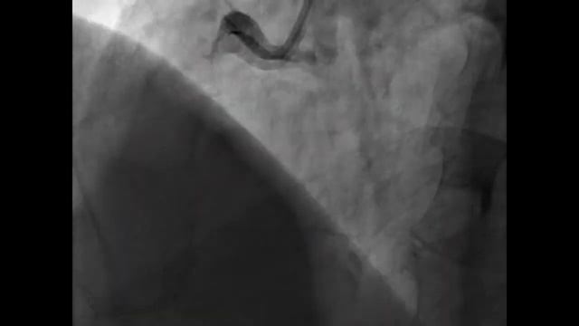 CORONARY ARTERY ANEURYSMS (русский)