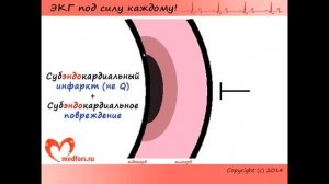 Изменения ЭКГ при инфарктах
