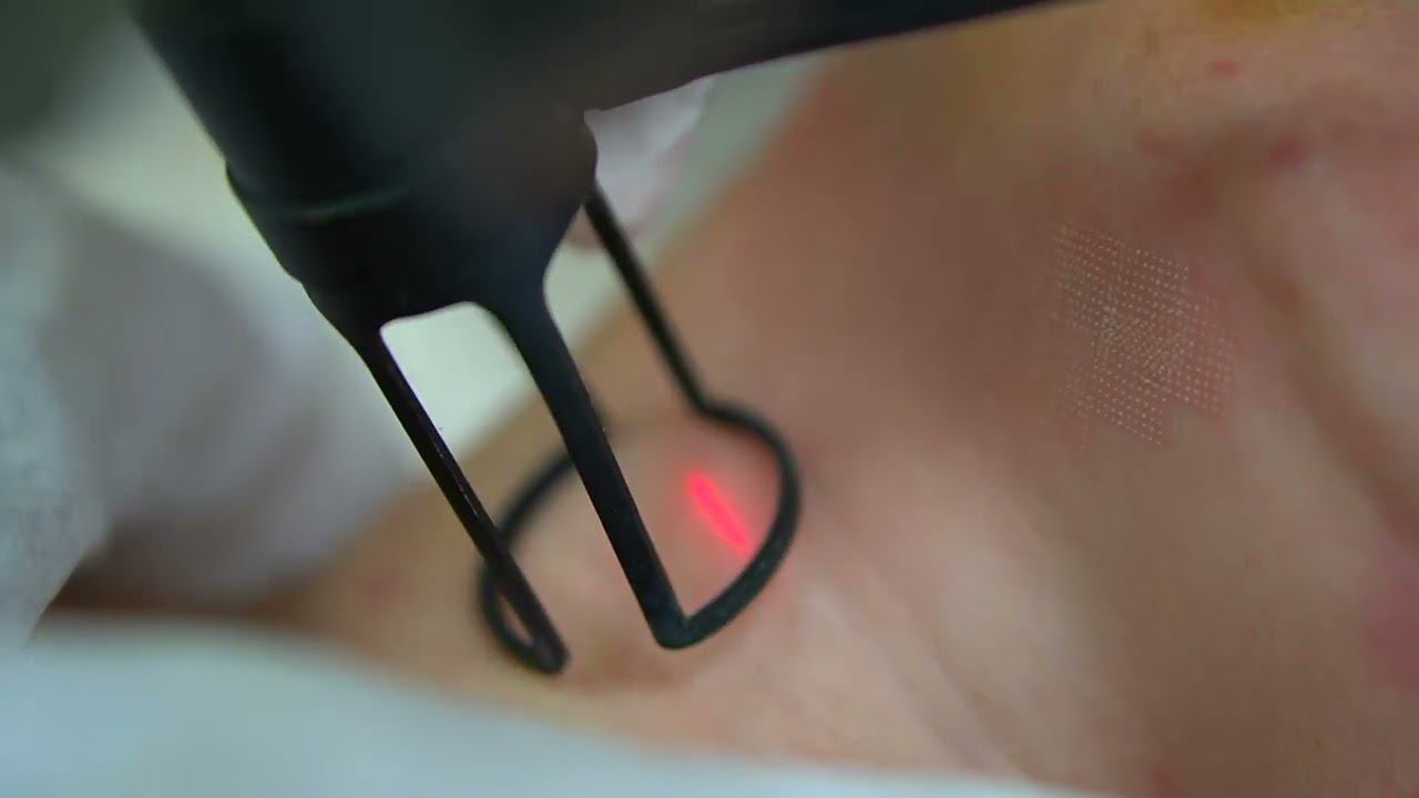 Фракционное лазерное омоложение смотреть онлайн