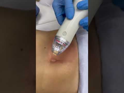 Устраняем #растяжки смотреть онлайн