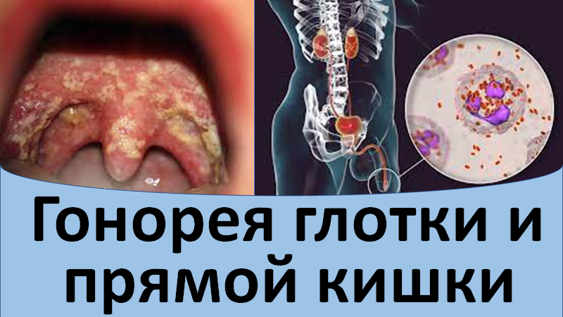 Гонорея глотки и прямой кишки смотреть онлайн