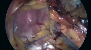 Laparoscopic TEP  Bilateral Inguinal Hernia