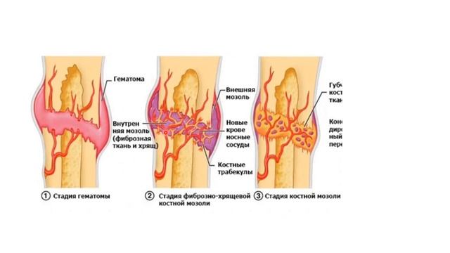 Регенерация кости. Видеокурс по травматологии смотреть онлайн