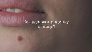Удаление родинки на лице. Как это делают?