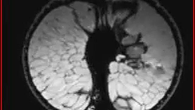Surface Coil Tangerine Volumetric MRI Scan смотреть онлайн