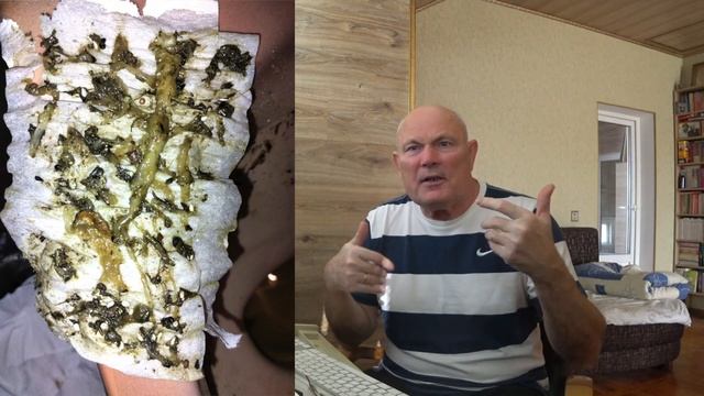 ГЛИСТЫ ДОХНУТ. ВЫШЛА ОГРОМНАЯ АСКАРИДА С СЕМЕЙСТВОМ. Малахов. смотреть онлайн