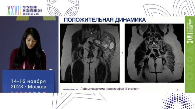 Оценка эффекта химиотерапии в лечении сарком по данным лучевых методов смотреть онлайн